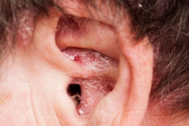 外耳湿疹耳朵结痂图