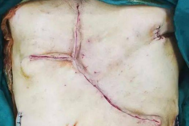 乳腺癌伤口渗血不愈合图 乳腺癌伤口渗血不愈合图