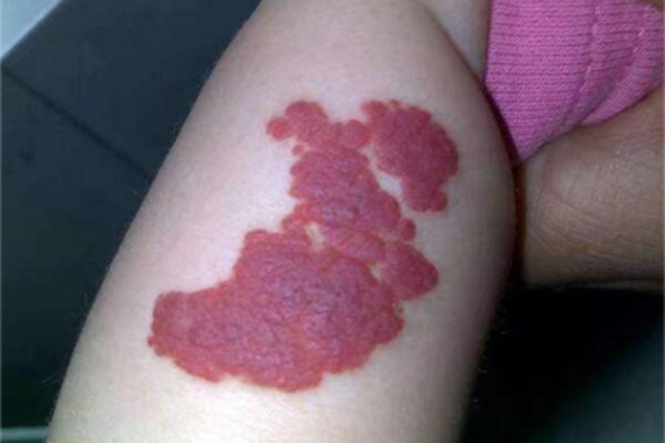 血管瘤疙瘩图 血管瘤疙瘩图