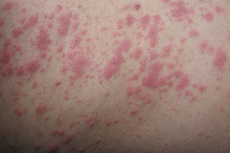 水肿性丘疹图