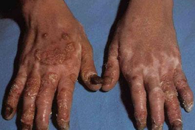 关节型银屑病图