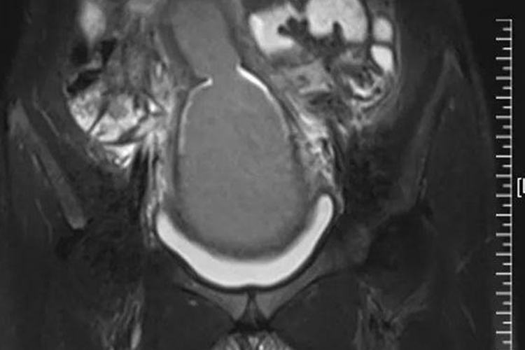 石女盆腔磁共振检查图