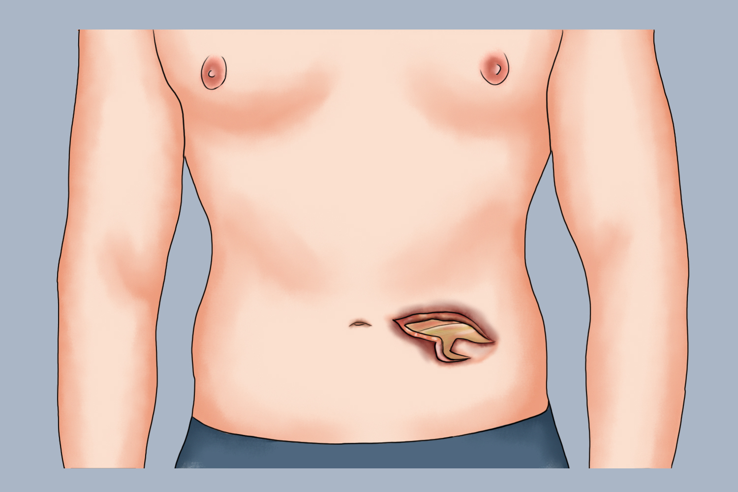 腹壁坏死性筋膜炎图 腹壁坏死性筋膜炎图