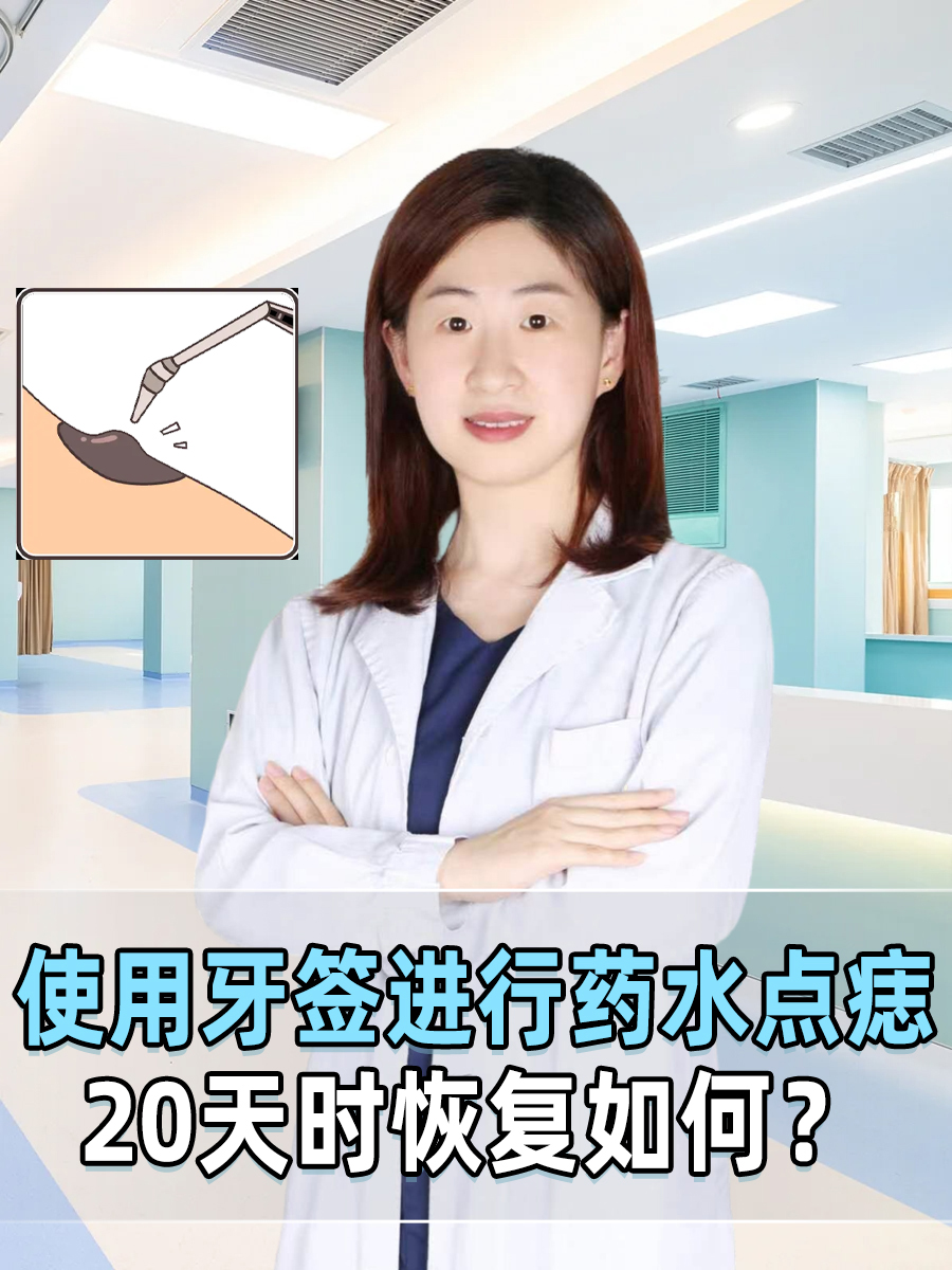 使用牙签进行药水点痣，20天时恢复如何？