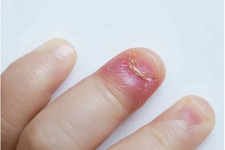 咬甲癖手指甲缩小图