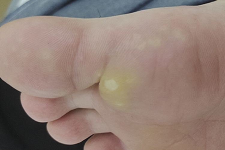 硬鸡眼脚部症状图