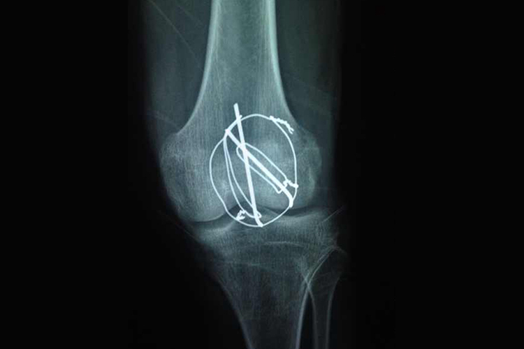 髌骨骨折钢钉图 髌骨骨折钢钉图