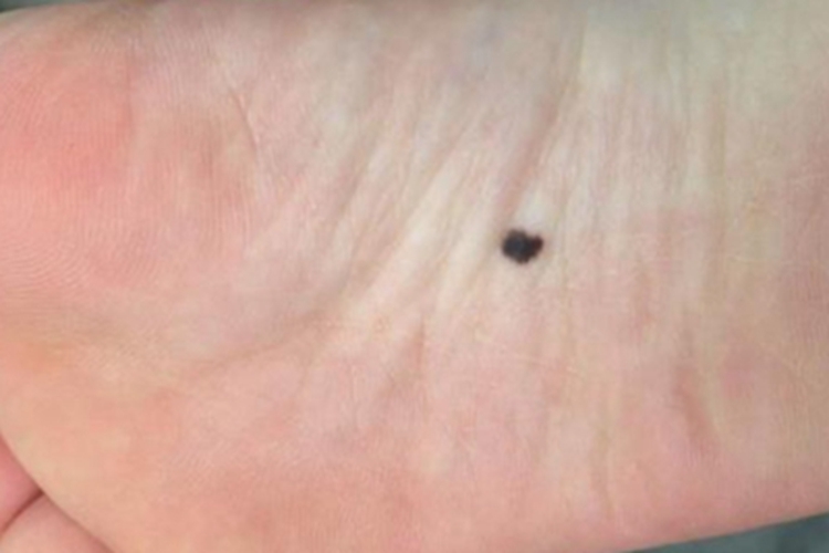 发育不良痣综合征症状图