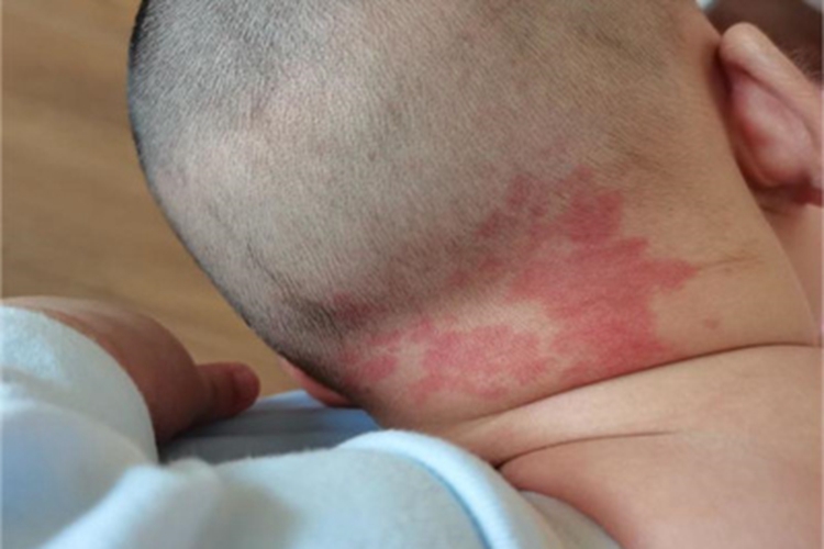 新生儿红斑后脖子长红斑图