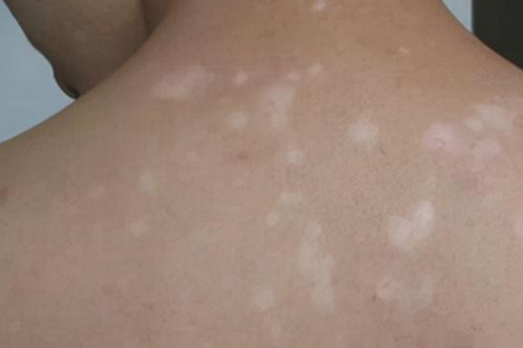 日光性白斑背部症状图 日光性白斑背部症状图