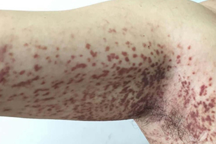 色素性荨麻疹症状图