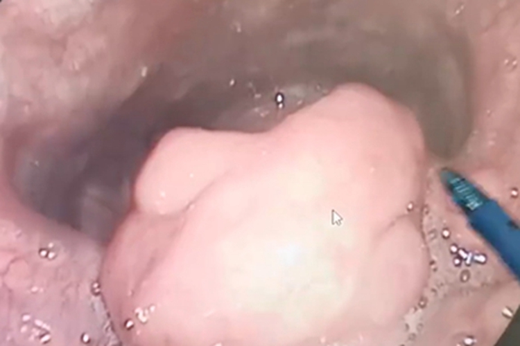 急性会厌炎水肿图 急性会厌炎水肿图