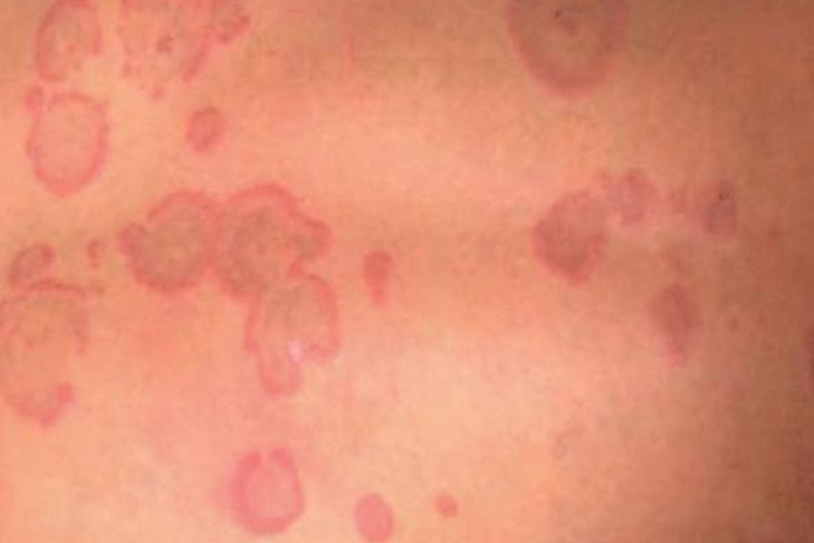 持久性色素异常性红斑图