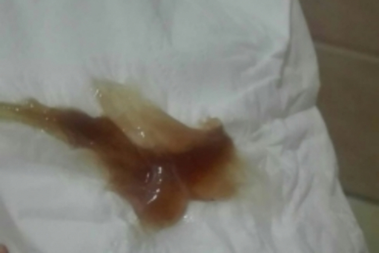 排出褐色黏稠分泌物图