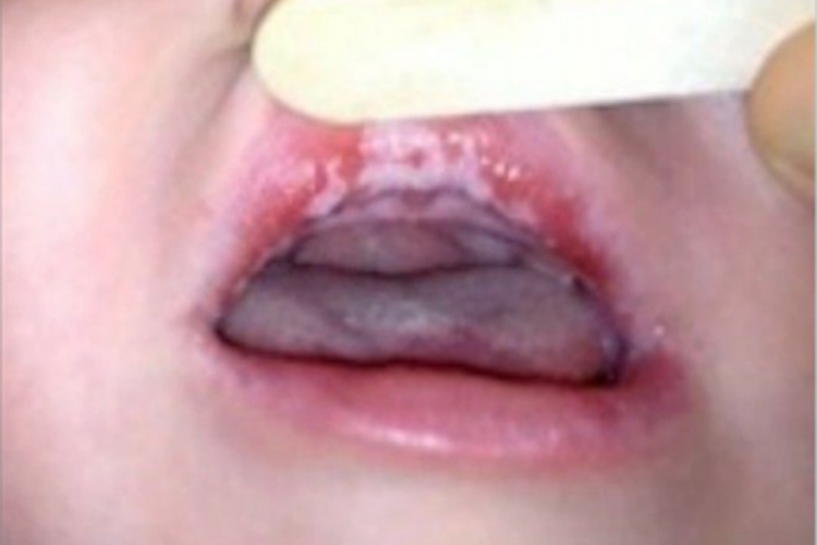 鹅口疮上嘴唇大片白斑图