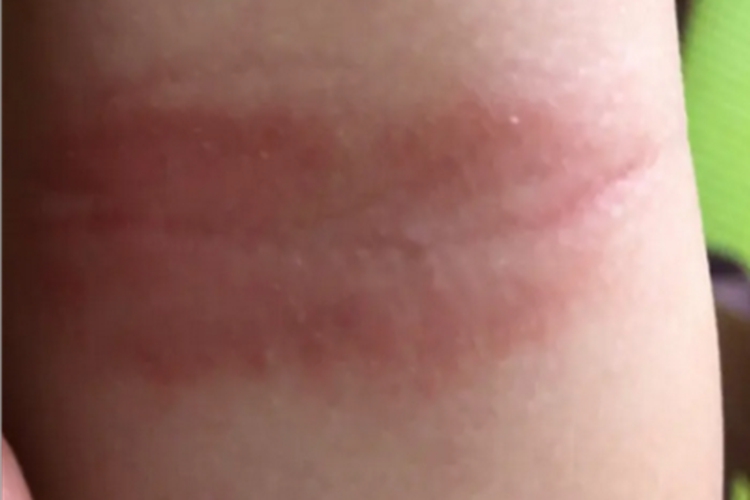 奶癣胳膊条状红斑有鳞屑图