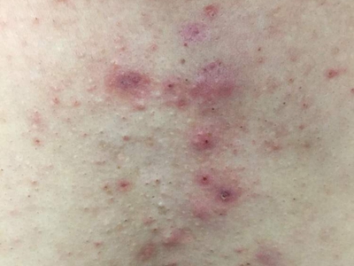 毛囊炎胸部长一片小红疙瘩破溃结痂图.jpg