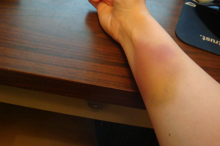 拍打过重手腕拍出瘀血图