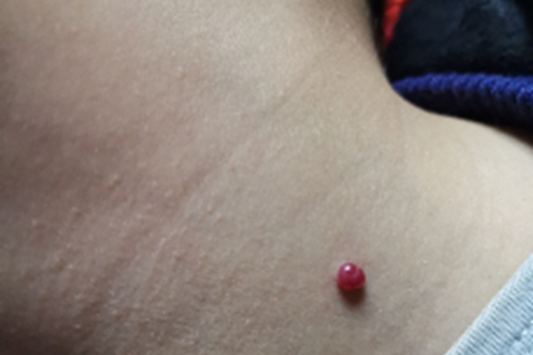 化脓性肉芽肿后颈小红疙瘩图