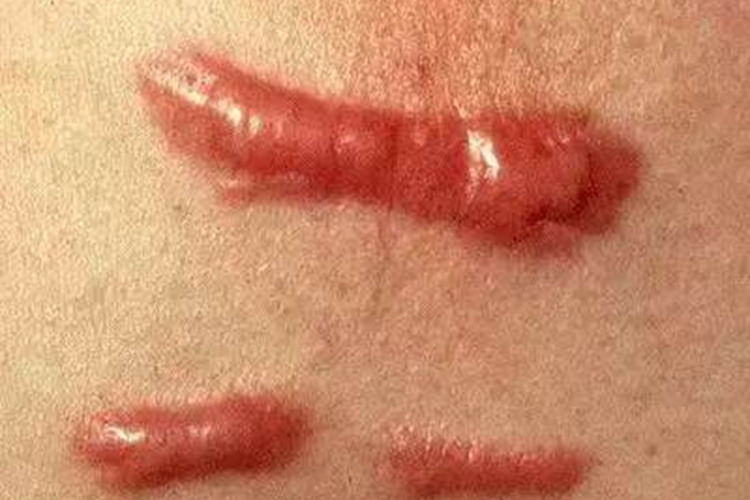 伤口愈合鲜红色图 伤口愈合鲜红色图