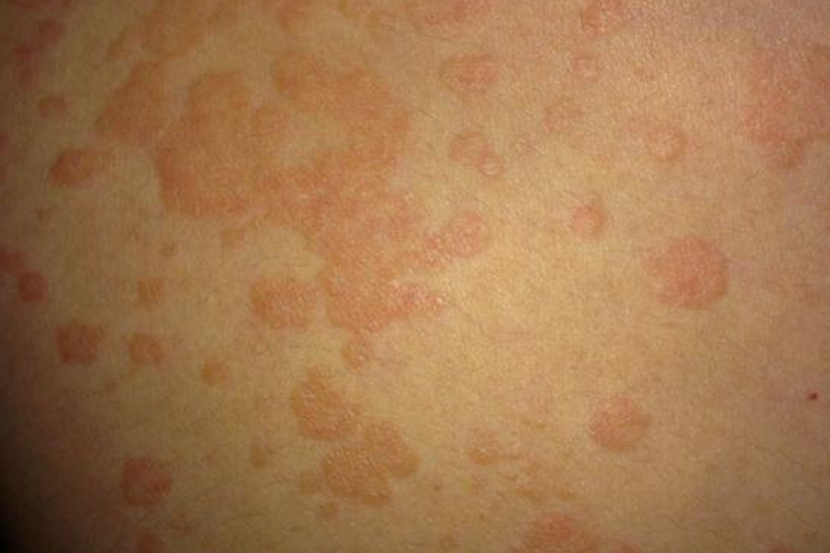 鱿鱼过敏皮肤红肿图 鱿鱼过敏皮肤红肿图