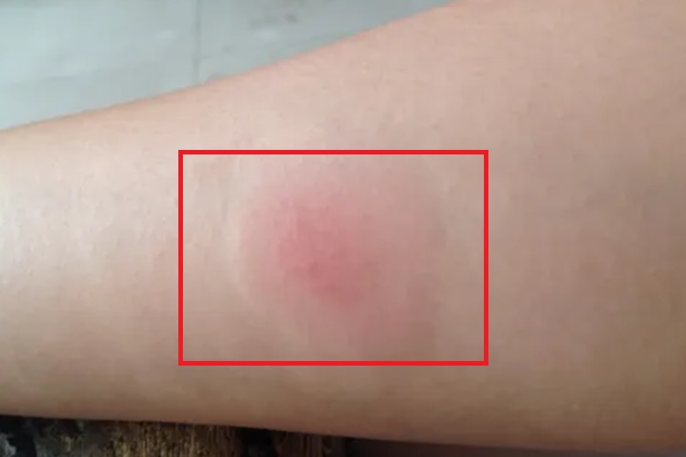 结核皮试手上有红斑图