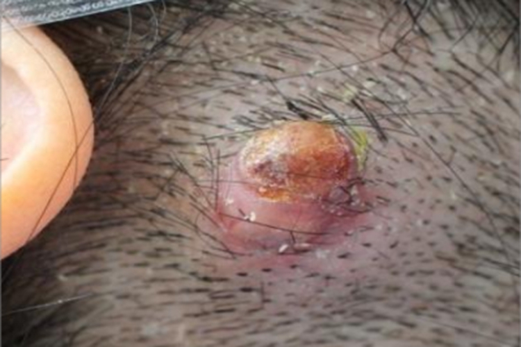 毛根鞘囊肿头皮症状图