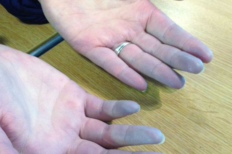 系统性硬皮病图 系统性硬皮病图