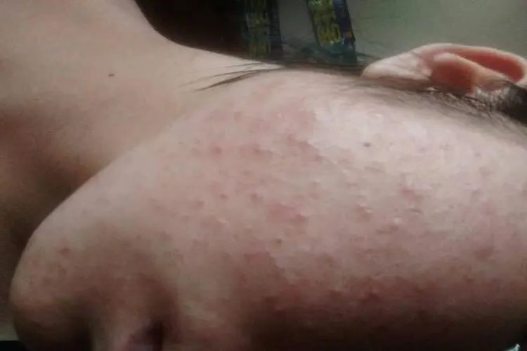 螨虫叮咬皮损图