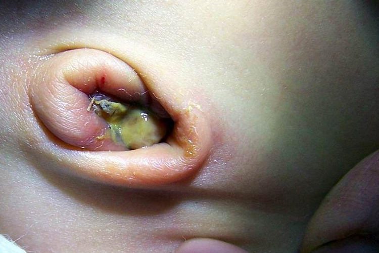 新生儿脐炎化脓图