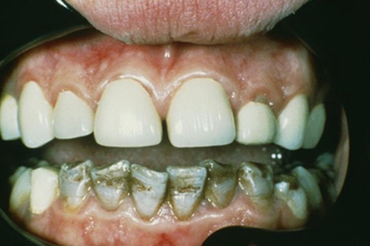 重度四环素牙凹凸不平图 重度四环素牙凹凸不平图