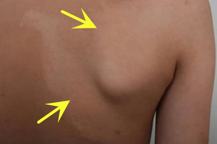 脱色素性痣背部症状图 脱色素性痣背部症状图