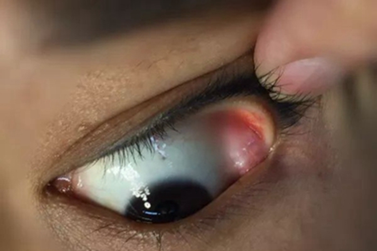 泪腺脱垂眼球肿块图