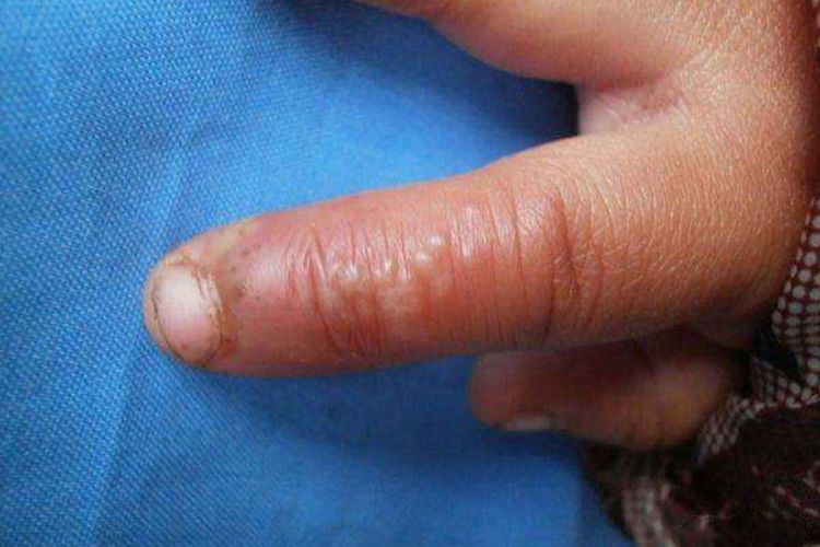 接种性疱疹图 接种性疱疹图