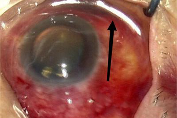 玻璃体疝眼球症状图