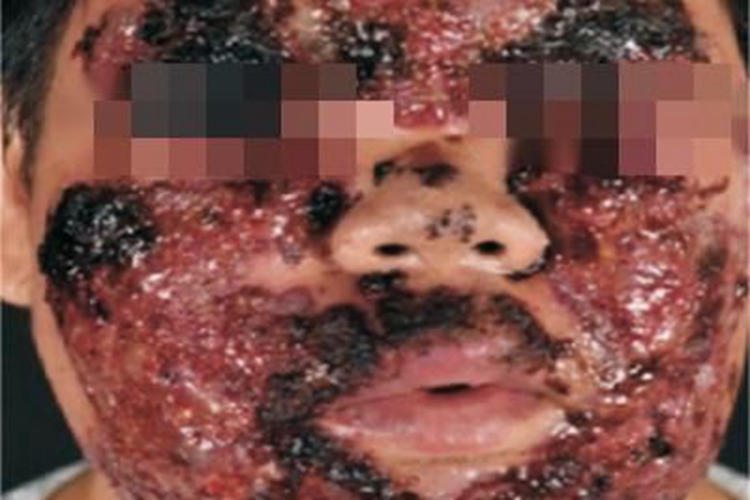 暴发性痤疮面部糜烂图 暴发性痤疮面部糜烂图