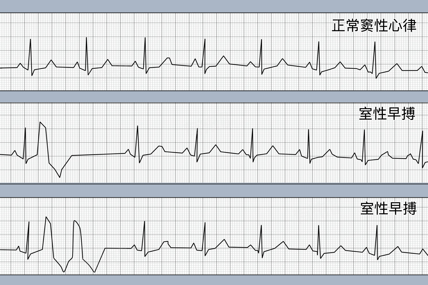 室性早搏是什么