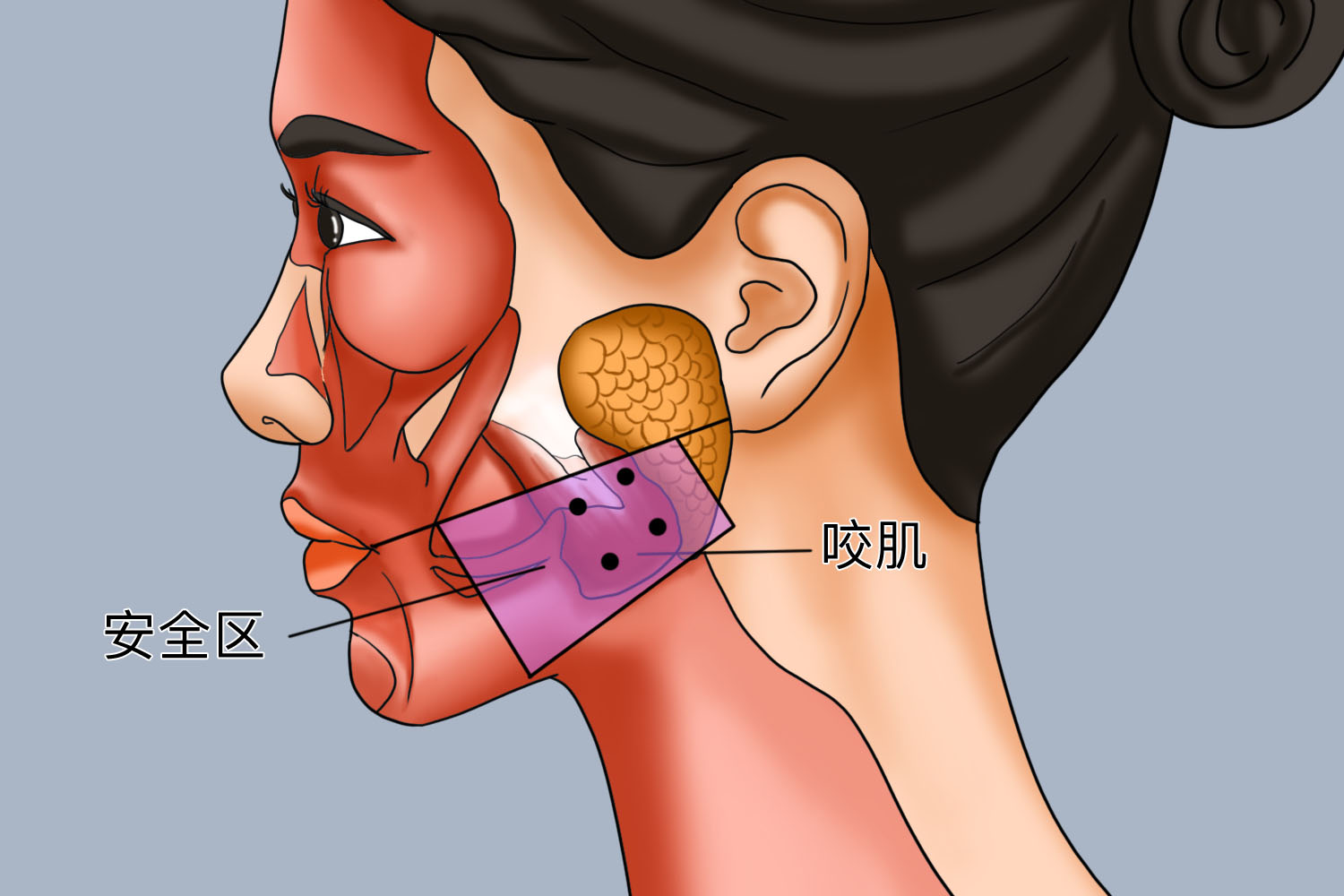 下颌咬肌注射点位图 下颌咬肌注射点位图