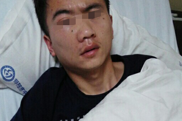 鼻腔鼻窦恶性肿瘤面部不对称图