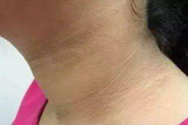 脖子黑棘皮病图片_有来医生