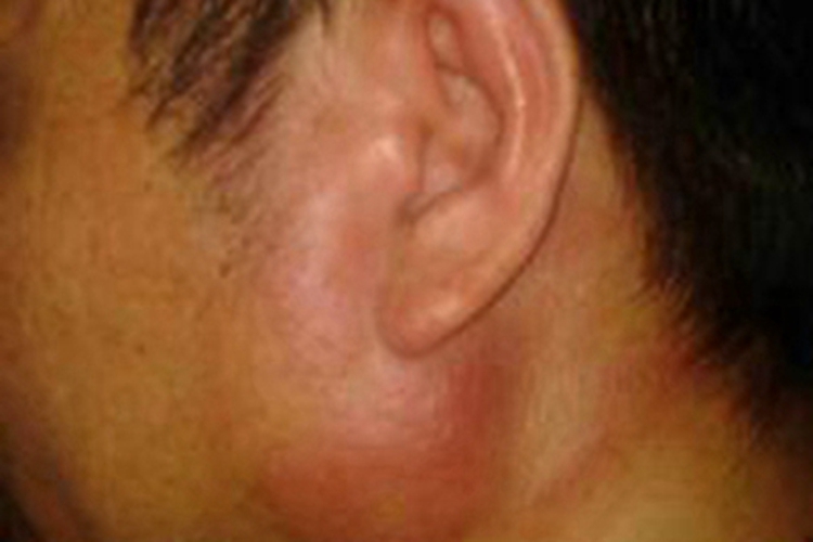 急性化脓性腮腺炎红肿图