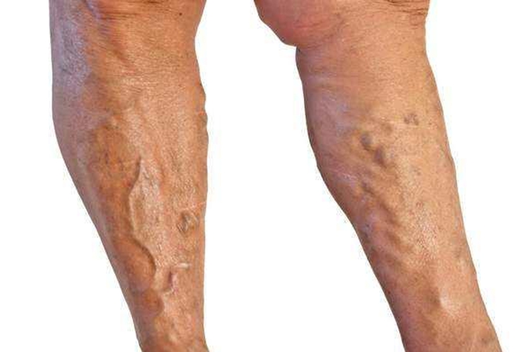 小腿静脉窦鼓包图