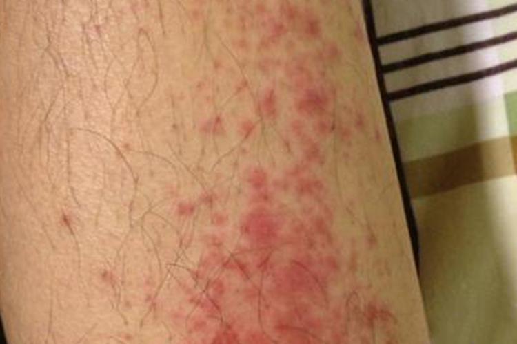 急性接触性皮炎图