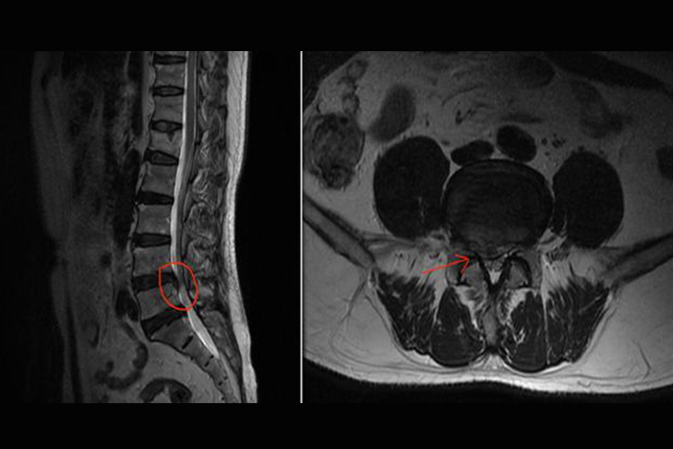 腰椎间盘突出症压迫神经影像图