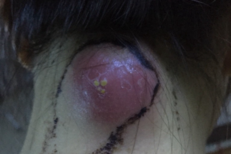 面颈部放线菌病后颈症状图