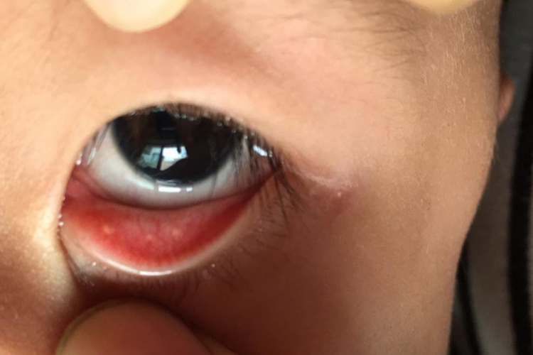 宝宝结膜结石图