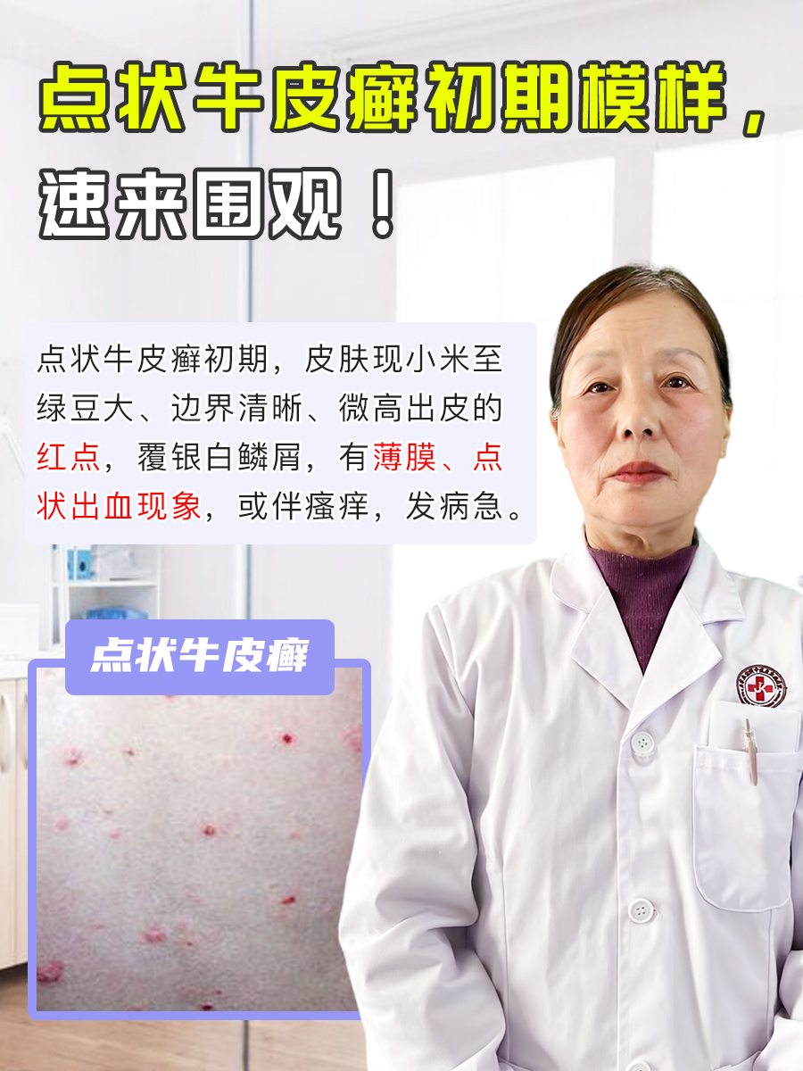 点状牛皮癣初期模样,速来围观!