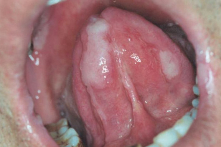 三期梅毒口腔白斑图