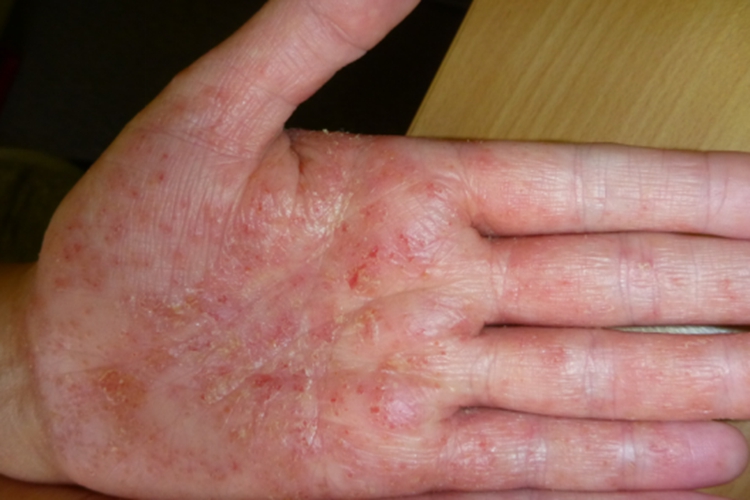 手掌部手癣图