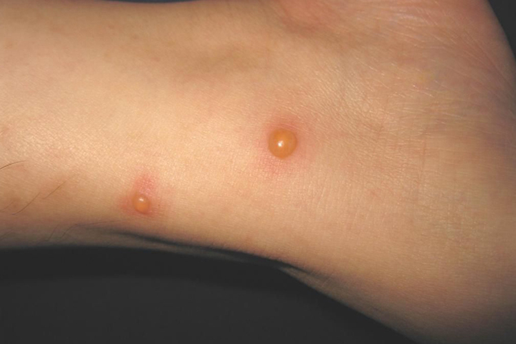 脚上丘疹性荨麻疹水疱图 脚上丘疹性荨麻疹水疱图